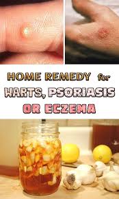 One Of The Most Beneficial Ingredient For Your Health Has Proved To Be Garlic It Has Many Pr Home Remedies For Warts Warts Remedy Home Remedies For Psoriasis