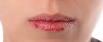 Ağız Yarası Nedir? Ağız Yarası Belirtileri ve Tedavisi