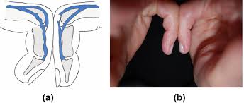 Image result for Elson Extensor Tendon Test