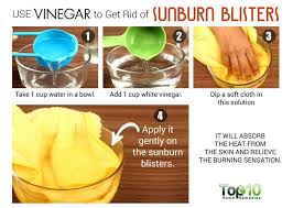 How To Get Rid Of Sunburn Blisters Top 10 Home Remedies Sunburn Blisters Get Rid Of Sunburn Vinegar For Sunburn