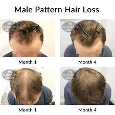 Read 1 more review about belgravia rentals only the latest review will count in the company's trustscore harry 1 review. The Belgravia Hair Loss Centre Photos Facebook