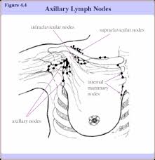 One of the first visible spots where these tumors metastasize is one of the left supraclavicular lymph node. Breast Cancer Lymph Node Status
