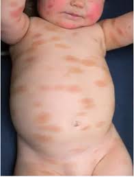 Image result for Urticaria pigmentosa children