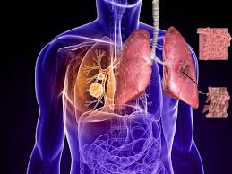 Penyakit merupakan sebuah kondisi tidak normalnya sebuah perangkat organ yang ada di dalam tubuh manusia yang. Cara Sederhana Dalam Mengobati Gejala Penyakit Paru Obstruktif Kronis Apotekers