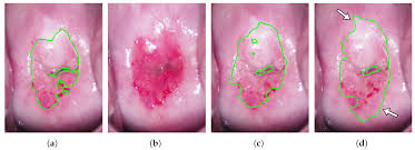 Image result for Colposcopy Findings