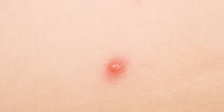 These types of pimples, though painful, are not indicative of having an std and usually clear up with proper hygiene. Yes That S Acne On Your Vagina Here S How To Treat It Prevention
