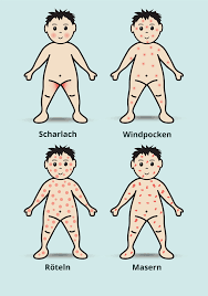 Scharlach Symptome Bilder Ausschlag Impfung Inkubationszeit Bei Kindern Und Erwachsenen