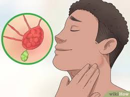 Eine schwellung der lymphknoten im achselbereich kann verschiedene ursachen haben. Lymphknoten Uberprufen 12 Schritte Mit Bildern Wikihow
