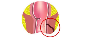 الناسور في فتحة الشرج ويب طب