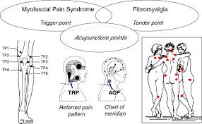 Close Relationships Among Trigger Points Acupuncture Points