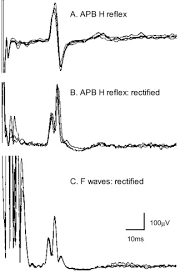 The following stepsshould be followed while performing this test: Clinical Uses Of H Reflexes Of Upper And Lower Limb Muscles Sciencedirect