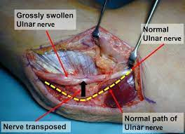 Cubital Tunnel Syndrome
