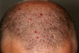 Image result for dry scabs on the head in children