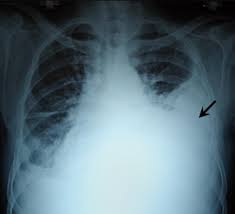 Hemothorax Wikipedia