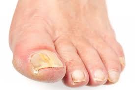 The most infectious period is thought to be 1 to 3 days before symptoms start, and in the first 7 days after symptoms begin. How Long Does A Fungal Toenail Infection Last Do Tobell