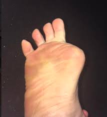 Image result for toe amputation