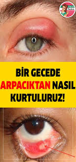 Bir Gecede Arpaciktan Nasil Kurtuluruz Natural Health Remedies Health Remedies Health