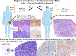 Image result for Merkel Cell Carcinoma