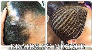14 Extraordinary Alopecia Camouflage Cornrows By Braids By Necole Black Hair Information Braids For Thin Hair Alopecia Natural Hair Alopecia Hairstyles