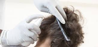 كيفية التخلص من القمل والصيبان بأسرع وقت موضوع