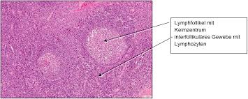 Image result for tonsilla palatina