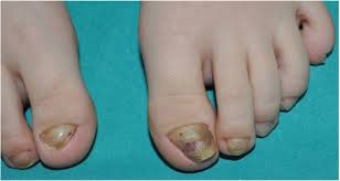 Image result for Koilonychia feet