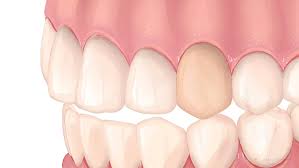 Image result for Tooth Discoloration