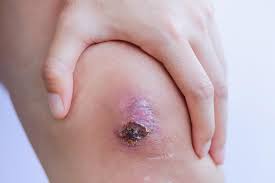 Read about exercises for knee injury, and learn about symptoms, signs, treatment, home remedies, recovery times and discover common causes of knee injuries and what a meniscus tear feels like. Infected Scab How To Identify And Treat Infections