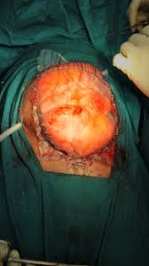 The bogota bag was placed as per standard published descriptions and consisted of sewing an empty, sterilized polyvinyl chloride irrigation fluid bag to the skin of the anterior abdominal wall [9. Standard Urine Collection Bag As An Improvised Bogota Bag As A Temporary Abdominal Closure Method In An Open Abdomen In Preventing Abdominal Compartment Syndrome