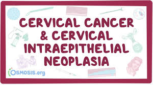 Cervical cancer occurs in the cells of the cervix (the neck of the womb), the lowest part of the uterus (womb) that connect the uterus with the vagina. Cervical Cancer Intraepithelial Neoplasia Causes Symptoms Diagnosis Treatment Pathology Youtube