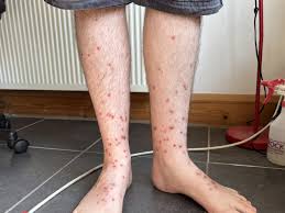 Image result for bedbugs bites