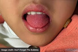 Image result for Strep throat infection roof of mouth
