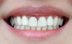 The bleaching agents are solely used on your teeth, and the process is carefully administered by a dentist. Orthodontics Complete Smiles