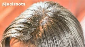 Goodbye Dry Itchy Dandruff Scalp Vegan Hair Hair Skin Dandruff