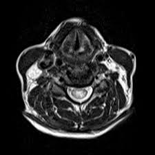 Exclusion is usually performed by magnetic resonance imaging (mri). Longitudinally Extensive Transverse Myelitis A Rare Neuromyelitis Optica Spectrum Disorder Consultant360