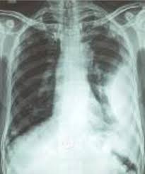 Fluid in the major fissure. Pleural Effusion Diagnosis Treatment And Management Abstract Europe Pmc