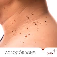 Richter Dermatologia Os Acrocordons Geralmente Sao Inofensivos E Indolores Sao Pequenas E Macias Protuberancias Na Pele Muitas Vezes No Pescoco Na Parte Superior Do Torax Nas Axilas E Nas Palpebras Eles