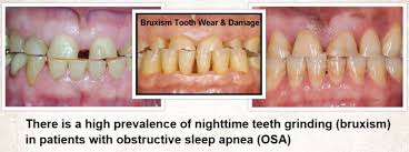 Bruxism And Sleep Apnea Osa And Teeth Grinding Pasadena