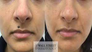 How to remove small moles. Ldnxu0lmob2gem