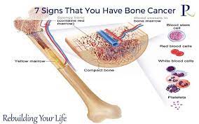 Some people with bone cancer are able to feel a lump or mass if the bone tumor is in a location that can be detected by touch. Read About 7 Signs That You Have Bone Cancer