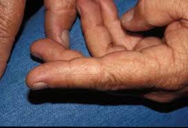 Image result for dyshidrosis