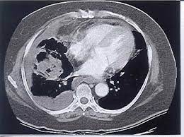 Pleural effusions occur as a result of increased fluid formation and/or reduced fluid resorption. Chest Ct Scan On The 11th Day After Admission Shows Loculated Pleural Download Scientific Diagram
