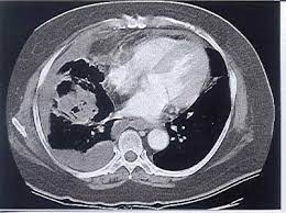 Pleural effusion is an accumulation of fluid in the pleural cavity between the lining of the lungs and the thoracic cavity (i.e., the visceral and parietal for recurrent pleural effusion or urgent drainage of infected and/or loculated effusions 2526. Chest Ct Scan On The 11th Day After Admission Shows Loculated Pleural Download Scientific Diagram