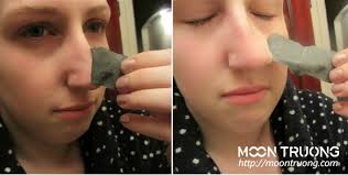 Có nên sử dụng miếng dán lột mụn thường xuyên?