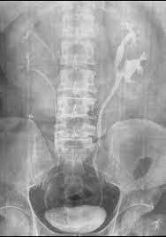Bilateral Duplex Kidney Radiology Case Radiopaedia Org