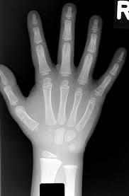 Bei der renalen osteopathie handelt es sich um eine erkrankung, die im zusammenhang mit einer chronischen schwäche der nierenfunktion steht. Pedirad