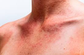 Explore images of squamous cell carcinoma and the early signs of damage to the skin, including abnormal discoloration, wrinkling, and skin cancer, can result from overexposure to the sun. Skin Care In Plano Tx Options For Sun Damaged Skin