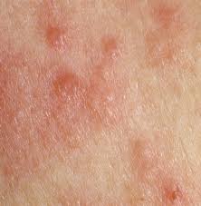 Dermatologic Manifestations Of Rheumatoid Arthritis Rheumatology Advisor