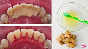 Oct 27, 2020 · trying home remedies download article 1. How To Remove Tartar From Teeth At Home Naturally Natural Ways To Remove Tartar Buildup Youtube