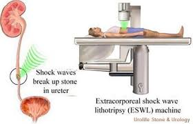 Shockwave Lithotripsy Eswl Kidney Stones Kidney Laser Treatment
